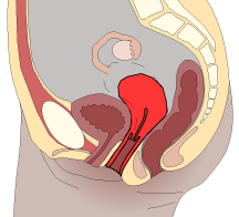 1st Degree Uterine Prolapse