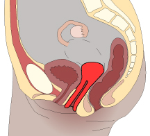 2nd Degree Uterine Prolapse