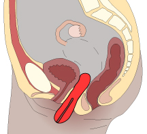 3rd Degree Uterine Prolapse